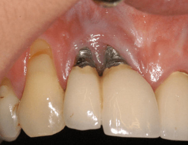 Vì sao trụ Implant có thể bị đào thải? Dấu hiệu cảnh báo sớm
